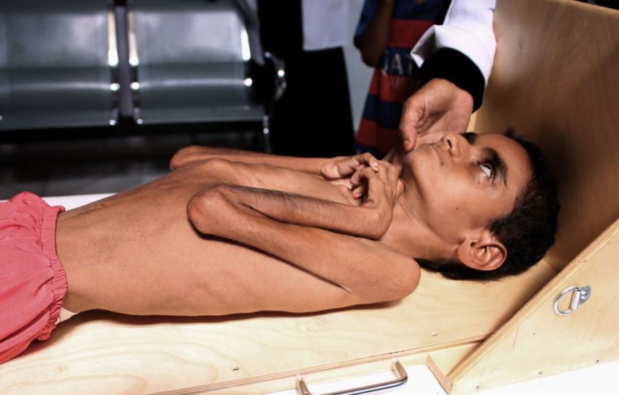 Shocking pictures of Yemeni children suffering from malnutrition will break your heart! Yemeni children,Devastating pictures of Yemeni children,Yemeni children malnutrition,malnutrition Yemeni children,malnutrition children