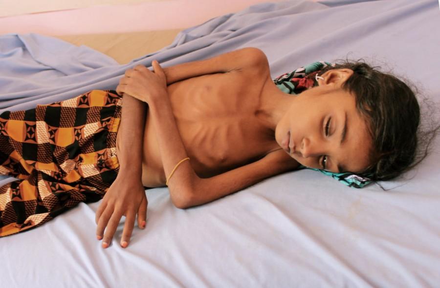 Shocking pictures of Yemeni children suffering from malnutrition will break your heart! Yemeni children,Devastating pictures of Yemeni children,Yemeni children malnutrition,malnutrition Yemeni children,malnutrition children