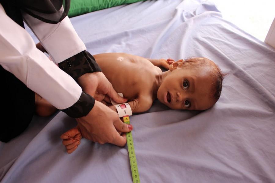 Shocking pictures of Yemeni children suffering from malnutrition will break your heart! Yemeni children,Devastating pictures of Yemeni children,Yemeni children malnutrition,malnutrition Yemeni children,malnutrition children
