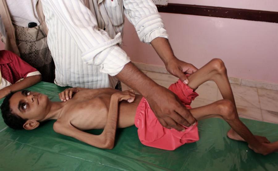 Shocking pictures of Yemeni children suffering from malnutrition will break your heart! Yemeni children,Devastating pictures of Yemeni children,Yemeni children malnutrition,malnutrition Yemeni children,malnutrition children