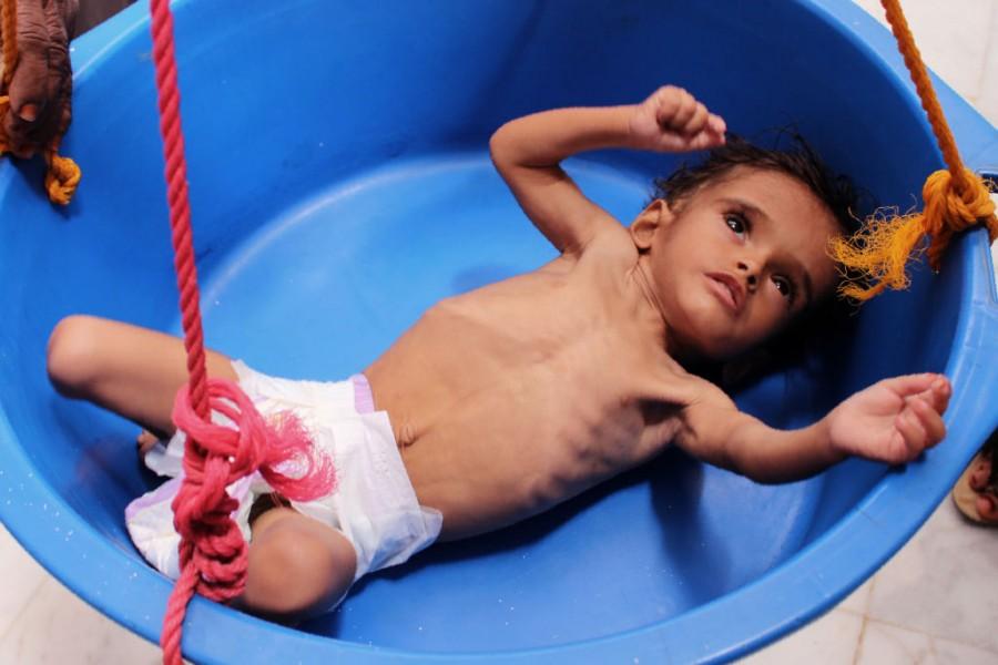 Shocking pictures of Yemeni children suffering from malnutrition will break your heart! Yemeni children,Devastating pictures of Yemeni children,Yemeni children malnutrition,malnutrition Yemeni children,malnutrition children