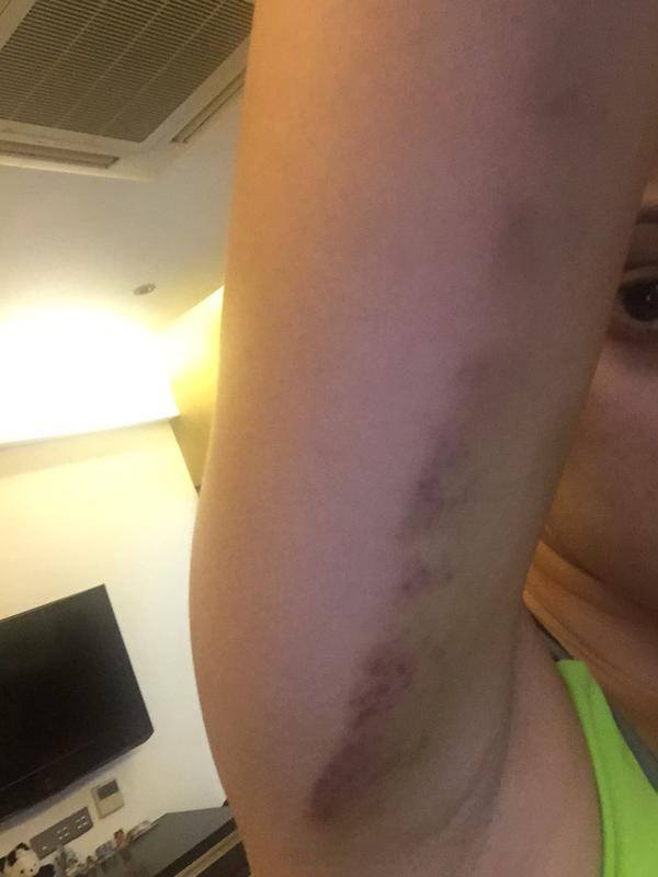 South Indian actress Raai Laxmi was injured during the stunt shooting of her upcoming film 'Sawkarpettai?' Raai laxmi,raai laxmi injured,raai laxmi sawkarpettai,sawkarpettai,sawkarpettai stunt shooting,sawkarpettai actress injured,raai laxmi injured sawkarpettai