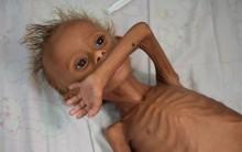 An estimated 320,000 children risk severe acute malnutrition and nearly 10 million children require humanitarian aid to prevent a further deterioration in Yemen according to UNICEF.