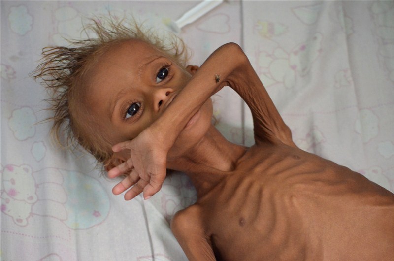 An estimated 320,000 children risk severe acute malnutrition and nearly 10 million children require humanitarian aid to prevent a further deterioration in Yemen according to UNICEF. Starving children of Yemen,Starving children,UNICEF,Yemen,Yemen childrens,Horrifying images,Horrifying imagesof Childrens