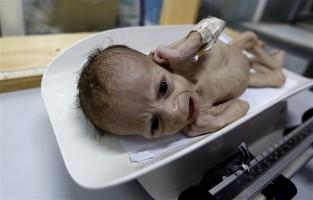 Starving children of Yemen,Starving children,UNICEF,Yemen,Yemen childrens,Horrifying images,Horrifying imagesof Childrens