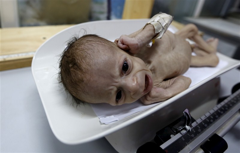 An estimated 320,000 children risk severe acute malnutrition and nearly 10 million children require humanitarian aid to prevent a further deterioration in Yemen according to UNICEF. Starving children of Yemen,Starving children,UNICEF,Yemen,Yemen childrens,Horrifying images,Horrifying imagesof Childrens