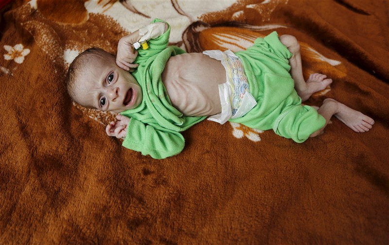 An estimated 320,000 children risk severe acute malnutrition and nearly 10 million children require humanitarian aid to prevent a further deterioration in Yemen according to UNICEF. Starving children of Yemen,Starving children,UNICEF,Yemen,Yemen childrens,Horrifying images,Horrifying imagesof Childrens