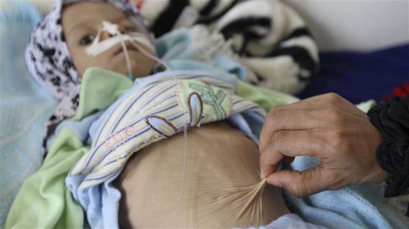 An estimated 320,000 children risk severe acute malnutrition and nearly 10 million children require humanitarian aid to prevent a further deterioration in Yemen according to UNICEF. Starving children of Yemen,Starving children,UNICEF,Yemen,Yemen childrens,Horrifying images,Horrifying imagesof Childrens