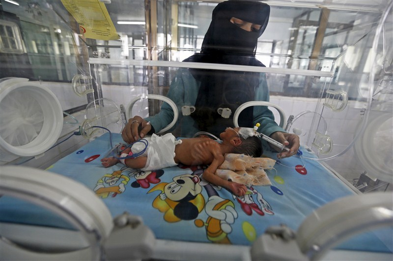 An estimated 320,000 children risk severe acute malnutrition and nearly 10 million children require humanitarian aid to prevent a further deterioration in Yemen according to UNICEF. Starving children of Yemen,Starving children,UNICEF,Yemen,Yemen childrens,Horrifying images,Horrifying imagesof Childrens