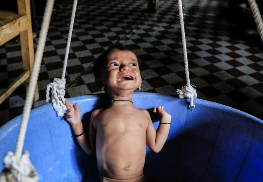 Sufated, a 10-month-old malnourished Rohingya boy, cries while being weighed at the Action Against Hunger center in Kutupalong refugee camp near Cox's Bazar, Bangladesh October 22, 2017. Rohingya refugee camps,Rohingya refugee,Myanmar,Inside the Rohingya refugee camps