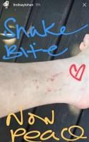 Actress Lindsay Lohan,Lindsay Lohan,Lindsay Lohan snake bite,Lindsay Lohan snake bite pics,Lindsay Lohan snake bite images,Lindsay Lohan snake bite stills,Lindsay Lohan snake bite pictures,Lindsay Lohan snake bite photos