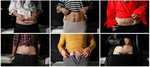 A combination picture shows women posing with new tattoos which cover their caesarean delivery (C-section) scars at Samurai Tattoo in Shanghai, China.