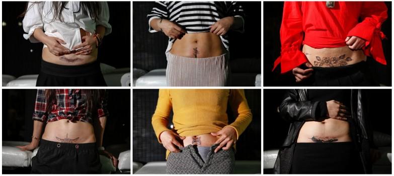 A combination picture shows women posing with new tattoos which cover their caesarean delivery (C-section) scars at Samurai Tattoo in Shanghai, China.